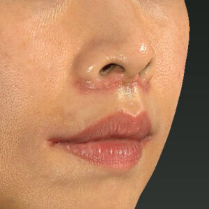 新宿ラクル美容外科クリニック　山本厚志　「人中短縮術（リップリフト）」　手術後１週間目　１０月１４日