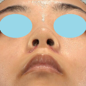 「小鼻縮小+α＋鼻尖縮小（close法）」　新宿ラクル美容外科クリニック　２０代女性　手術後１週間目　１０月１５日