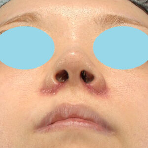 「耳介軟骨移植＋鼻尖縮小（close法）＋小鼻縮小+α＋貴族手術」　新宿ラクル美容外科クリニック　３０代女性　手術後１週間目　１０月２１日