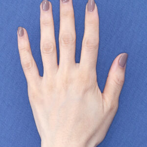 新宿ラクル美容外科クリニック　山本厚志　「手の若返り（プレミアムPRP×FGF皮膚再生療法）」　治療後１２ヶ月目　１１月１３日