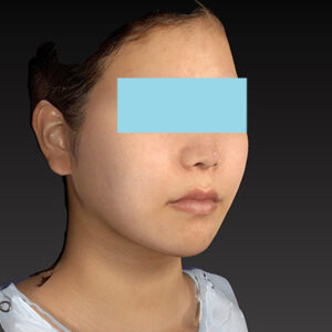 新宿ラクル美容外科クリニック　山本厚志　ナチュラルフェイスリフト　手術後１２ヶ月目　３月２９日