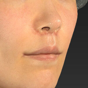 新宿ラクル美容外科クリニック　山本厚志　「人中短縮術（リップリフト）＋口角挙上（スマイルリップ）」　手術後１ヶ月目　１０月１１日