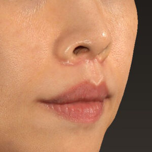 新宿ラクル美容外科クリニック　山本厚志　「人中短縮術（リップリフト）」　手術後１ヶ月目　１０月１４日