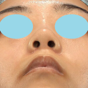 「小鼻縮小+α＋鼻尖縮小（close法）」　新宿ラクル美容外科クリニック　２０代女性　手術後１ヶ月目　１０月１５日