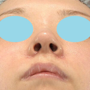 「耳介軟骨移植＋鼻尖縮小（close法）＋小鼻縮小+α＋貴族手術」　新宿ラクル美容外科クリニック　３０代女性　手術後１ヶ月目　１０月２１日