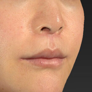 新宿ラクル美容外科クリニック　山本厚志　「人中短縮術（リップリフト）＋口角挙上（スマイルリップ）」　手術後２ヶ月目　１０月２８日