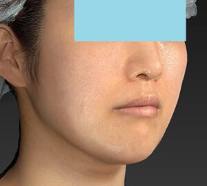 新宿ラクル美容外科クリニック　山本厚志　「ライポライフ脂肪吸引（メーラーファット）＋貴族手術」　手術後２ヶ月目　１０月１０日