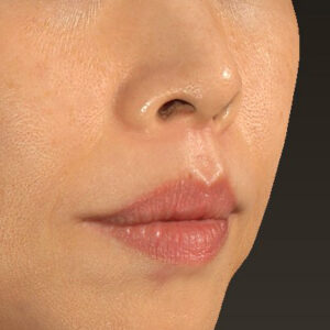 新宿ラクル美容外科クリニック　山本厚志　「人中短縮術（リップリフト）」　手術後２ヶ月目　１０月１４日