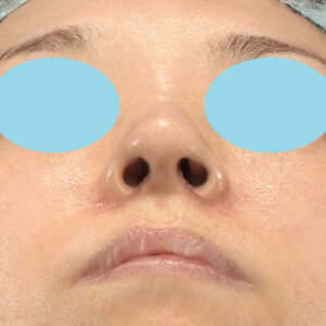 「耳介軟骨移植＋鼻尖縮小（close法）＋小鼻縮小+α＋貴族手術」　新宿ラクル美容外科クリニック　３０代女性　手術後２ヶ月目　１０月２１日