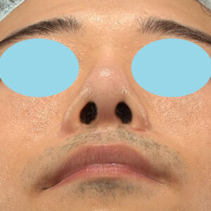 「鼻中隔延長＋耳介軟骨移植＋鼻尖形成＋鼻柱下降＋猫手術＋真皮脂肪移植（鼻尖）＋鼻プロテーゼ隆鼻術」　新宿ラクル美容外科クリニック　２０代女性　手術後２ヶ月目　１０月２２日