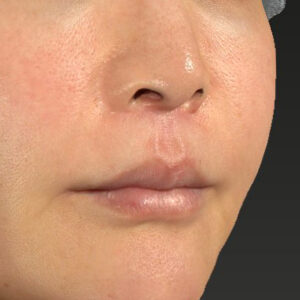 新宿ラクル美容外科クリニック　山本厚志　「人中短縮術（リップリフト）＋口角挙上（スマイルリップ）」　手術後３ヶ月目　１１月２４日