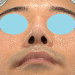 「鼻中隔延長＋耳介軟骨移植＋鼻尖形成＋鼻柱下降＋猫手術＋真皮脂肪移植（鼻尖）＋鼻プロテーゼ隆鼻術」　新宿ラクル美容外科クリニック　２０代女性　手術後３ヶ月目　１１月２６日