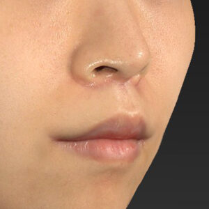 新宿ラクル美容外科クリニック　山本厚志　「人中短縮術（リップリフト）＋口角挙上（スマイルリップ）」　手術後３ヶ月目　１０月１３日