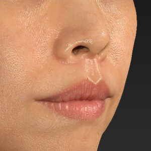 新宿ラクル美容外科クリニック　山本厚志　「人中短縮術（リップリフト）」　手術後３ヶ月目　１１月１１日