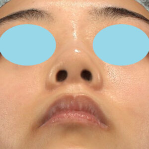 「小鼻縮小+α＋鼻尖縮小（close法）」　新宿ラクル美容外科クリニック　２０代女性　手術後３ヶ月目　１１月１６日