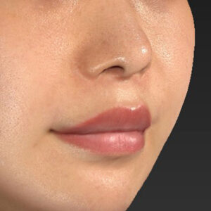 新宿ラクル美容外科クリニック　山本厚志　「人中短縮術（リップリフト）＋口角挙上（スマイルリップ）」　手術後６ヶ月目　１０月６日