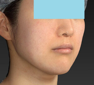 新宿ラクル美容外科クリニック　山本厚志　「ライポライフ脂肪吸引（メーラーファット）＋貴族手術」　手術後６ヶ月目　１２月１９日