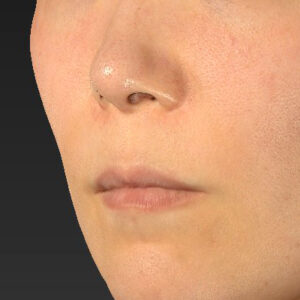 新宿ラクル美容外科クリニック　山本厚志　「人中短縮術（リップリフト）＋口角挙上（スマイルリップ）」　手術前　１０月１１日