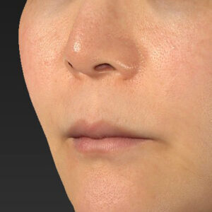 新宿ラクル美容外科クリニック　山本厚志　「人中短縮術（リップリフト）＋口角挙上（スマイルリップ）」　手術前　１０月２８日