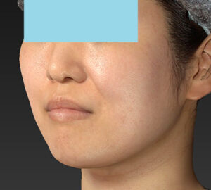 新宿ラクル美容外科クリニック　山本厚志　「ライポライフ脂肪吸引（メーラーファット）＋貴族手術」　手術前　１０月１０日