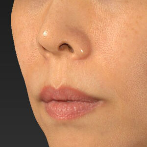 新宿ラクル美容外科クリニック　山本厚志　「人中短縮術（リップリフト）」　手術前　１０月１４日