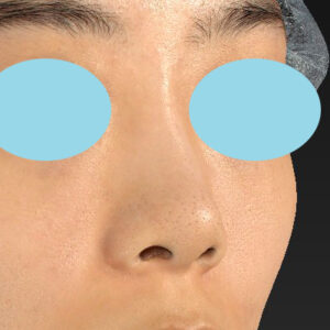 「小鼻縮小+α＋鼻尖縮小（close法）」　新宿ラクル美容外科クリニック　２０代女性　手術前　１０月１５日