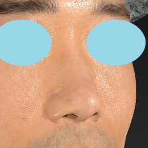 「鼻中隔延長＋耳介軟骨移植＋鼻尖形成＋鼻柱下降＋猫手術＋真皮脂肪移植（鼻尖）＋鼻プロテーゼ隆鼻術」　新宿ラクル美容外科クリニック　２０代女性　手術前　１０月２２日