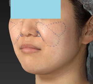 新宿ラクル美容外科クリニック　山本厚志　「ライポライフ脂肪吸引（メーラーファット）＋貴族手術」　デザイン　１０月１０日