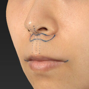 新宿ラクル美容外科クリニック　山本厚志　「人中短縮術（リップリフト）＋口角挙上（スマイルリップ）」　デザイン　１０月１３日