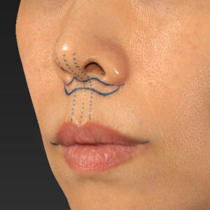 新宿ラクル美容外科クリニック　山本厚志　「人中短縮術（リップリフト）」　デザイン　１０月１４日