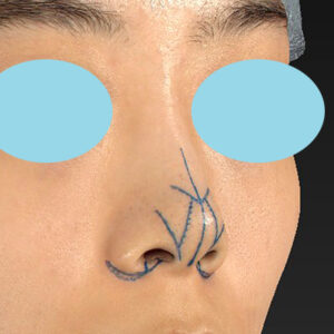 「小鼻縮小+α＋鼻尖縮小（close法）」　新宿ラクル美容外科クリニック　２０代女性　デザイン　１０月１５日