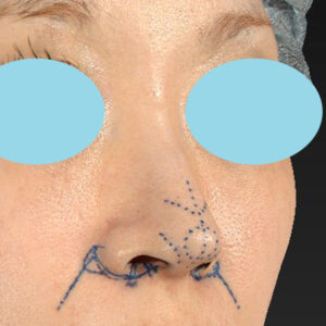 「耳介軟骨移植＋鼻尖縮小（close法）＋小鼻縮小+α＋貴族手術」　新宿ラクル美容外科クリニック　３０代女性　デザイン　１０月２１日