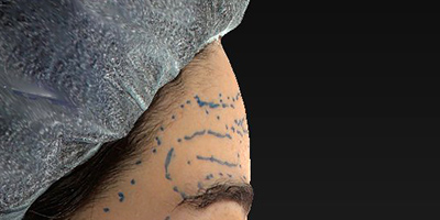 デザイン 新宿ラクル美容外科クリニック 山本厚志 「額の若返り(ジュビダームビスタ・ボリューマXC)」 デザイン 10月23日