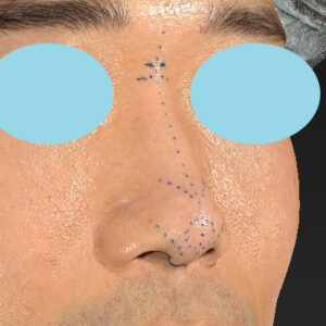 「鼻中隔延長＋耳介軟骨移植＋鼻尖形成＋鼻柱下降＋猫手術＋真皮脂肪移植（鼻尖）＋鼻プロテーゼ隆鼻術」　新宿ラクル美容外科クリニック　２０代女性　デザイン　１０月２２日