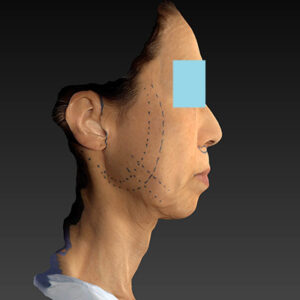 新宿ラクル美容外科クリニック　山本厚志　ナチュラルフェイスネックリフト　デザイン　１０月２５日