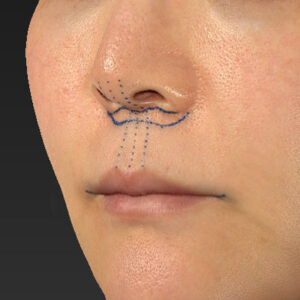 新宿ラクル美容外科クリニック　山本厚志　「人中短縮術（リップリフト）＋口角挙上（スマイルリップ）」　デザイン　１０月２８日