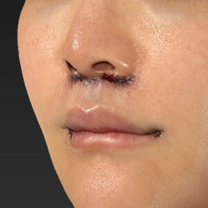 新宿ラクル美容外科クリニック　山本厚志　「人中短縮術（リップリフト）＋口角挙上（スマイルリップ）」　手術直後　１０月２８日