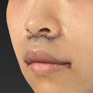 新宿ラクル美容外科クリニック　山本厚志　「人中短縮術（リップリフト）＋口角挙上（スマイルリップ）」　手術直後　１０月１３日