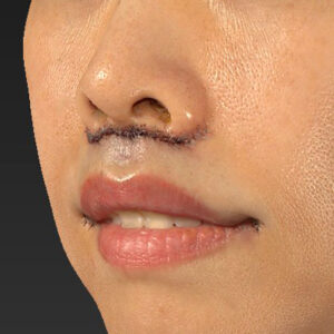 新宿ラクル美容外科クリニック　山本厚志　「人中短縮術（リップリフト）」　手術直後　１０月１４日