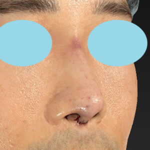 「鼻中隔延長＋耳介軟骨移植＋鼻尖形成＋鼻柱下降＋猫手術＋真皮脂肪移植（鼻尖）＋鼻プロテーゼ隆鼻術」　新宿ラクル美容外科クリニック　２０代女性　手術直後　１０月２２日