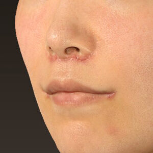 新宿ラクル美容外科クリニック　山本厚志　「人中短縮術（リップリフト）＋口角挙上（スマイルリップ）」　手術後１週間目　１０月１１日