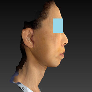 新宿ラクル美容外科クリニック　山本厚志　ナチュラルフェイスネックリフト　手術後１週間目　１０月２５日