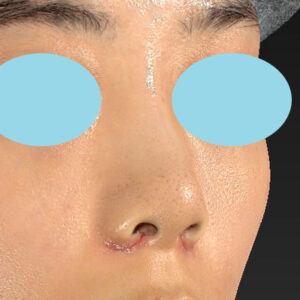 「小鼻縮小+α＋鼻尖縮小（close法）」　新宿ラクル美容外科クリニック　２０代女性　手術後１週間目　１０月１５日