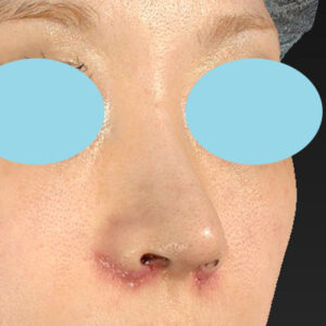 「耳介軟骨移植＋鼻尖縮小（close法）＋小鼻縮小+α＋貴族手術」　新宿ラクル美容外科クリニック　３０代女性　手術後１週間目　１０月２１日