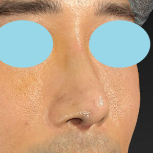 「鼻中隔延長＋耳介軟骨移植＋鼻尖形成＋鼻柱下降＋猫手術＋真皮脂肪移植（鼻尖）＋鼻プロテーゼ隆鼻術」　新宿ラクル美容外科クリニック　２０代女性　手術後１週間目　１０月２２日