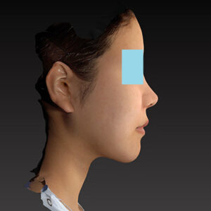 新宿ラクル美容外科クリニック　山本厚志　ナチュラルフェイスリフト　手術後１２ヶ月目　３月２９日