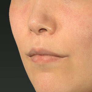 新宿ラクル美容外科クリニック　山本厚志　「人中短縮術（リップリフト）＋口角挙上（スマイルリップ）」　手術後１２ヶ月目　２月２０日