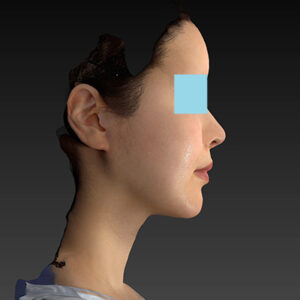 新宿ラクル美容外科クリニック　山本厚志　ナチュラルフェイスリフト　手術後１２ヶ月目　４月３０日