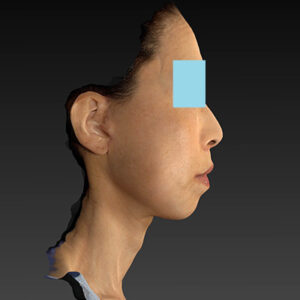 新宿ラクル美容外科クリニック　山本厚志　ナチュラルフェイスネックリフト　手術後１ヶ月目　１０月２５日