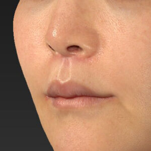 新宿ラクル美容外科クリニック　山本厚志　「人中短縮術（リップリフト）＋口角挙上（スマイルリップ）」　手術後１ヶ月目　１０月２８日